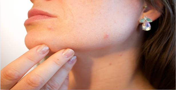 Acne Laser Treatment: London’s Biggest Questions Answered
